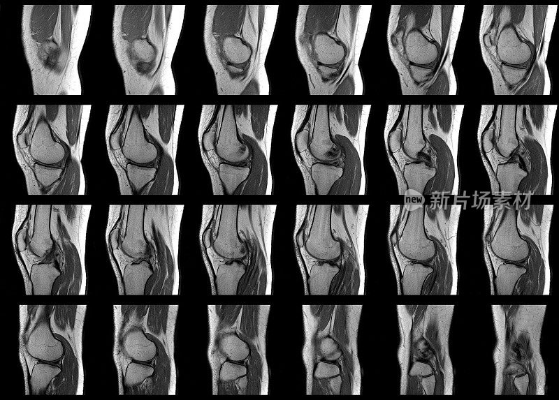 膝关节MRI扫描