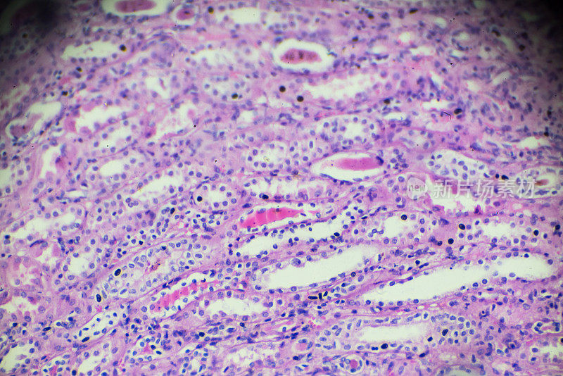 光镜下慢性肾盂肾炎活检