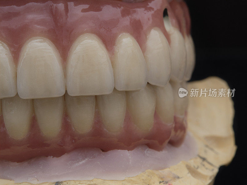 完整的上下金属烤瓷修复牙直接与种植体固定
