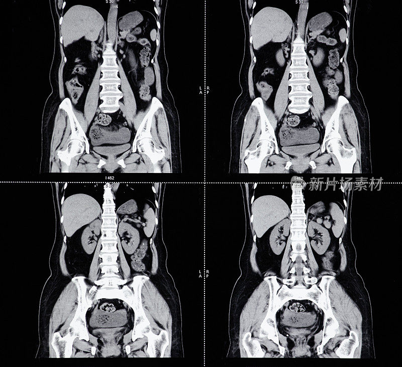 MRI扫描人体腹部断层扫描