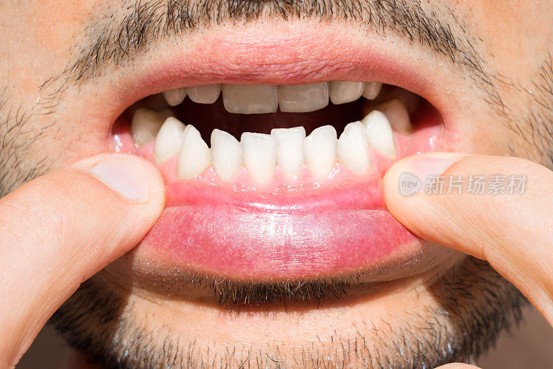 近距离的人嘴与弯曲的牙齿。安装牙套的原因。坏的牙齿