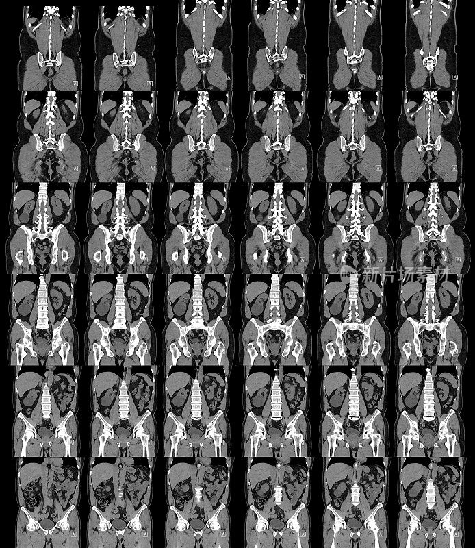 腹部骨盆Cat扫描正面视图