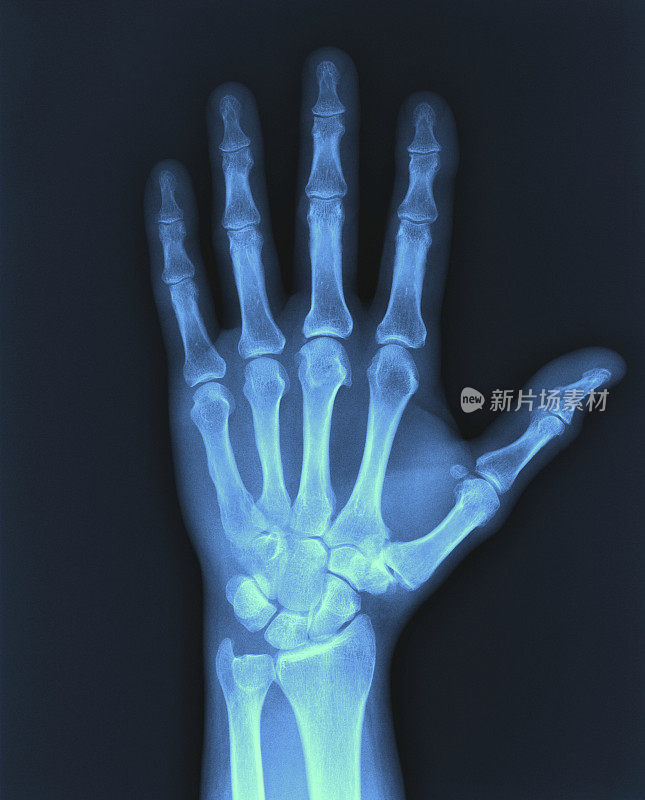 x射线的手。