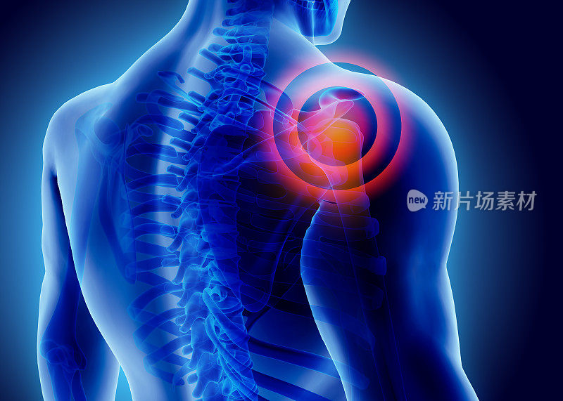 肩部疼痛的3D插图。
