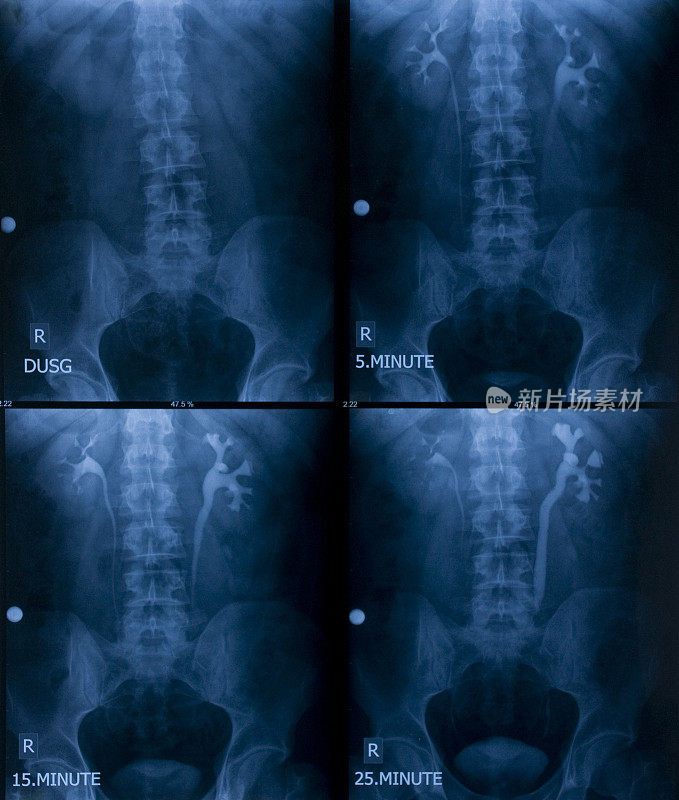 静脉肾盂造影x线照片