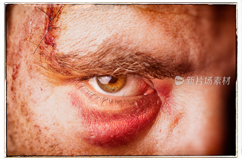 近距离伤，男子眼睛附近缝合的大伤口