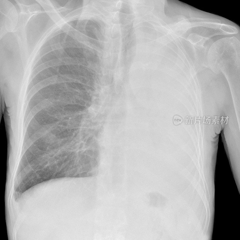 肺萎陷数字化胸部x光片(如哮喘和癌症)