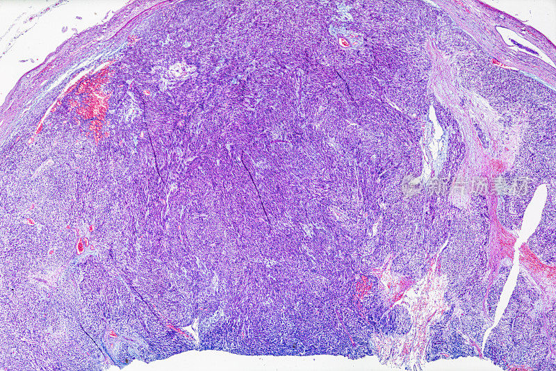 平滑肌瘤(子宫)活检标本在光镜下放大不同区域