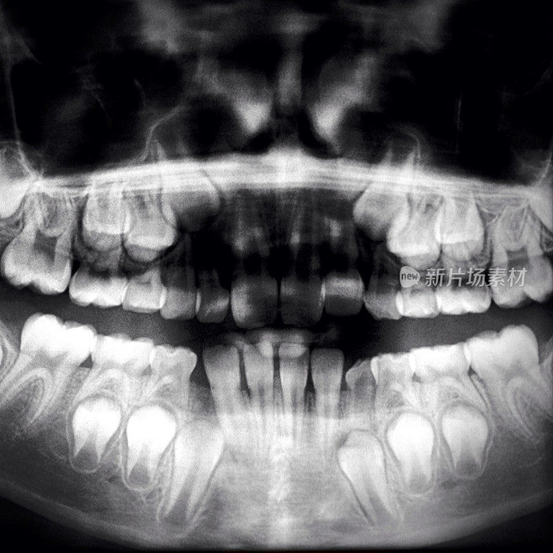 牙科x光图像