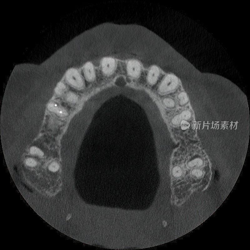 牙科断层扫描病人的CT扫描