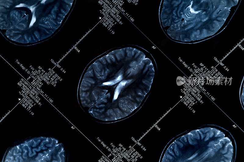 MRI脑部扫描显示头部和头骨的多个图像