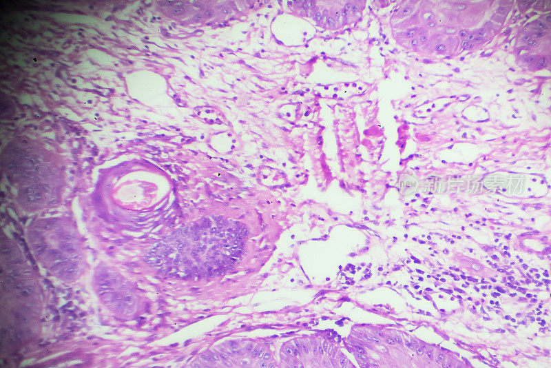 鳞状细胞癌显微镜下