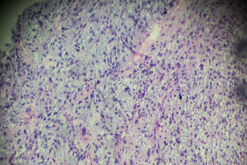 显微镜下横纹肌肉瘤活检