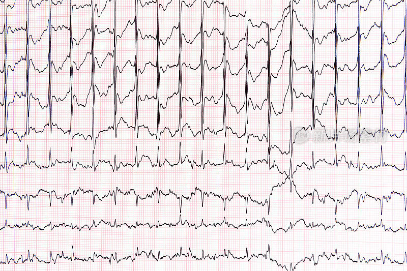 图表心电图(ECG)