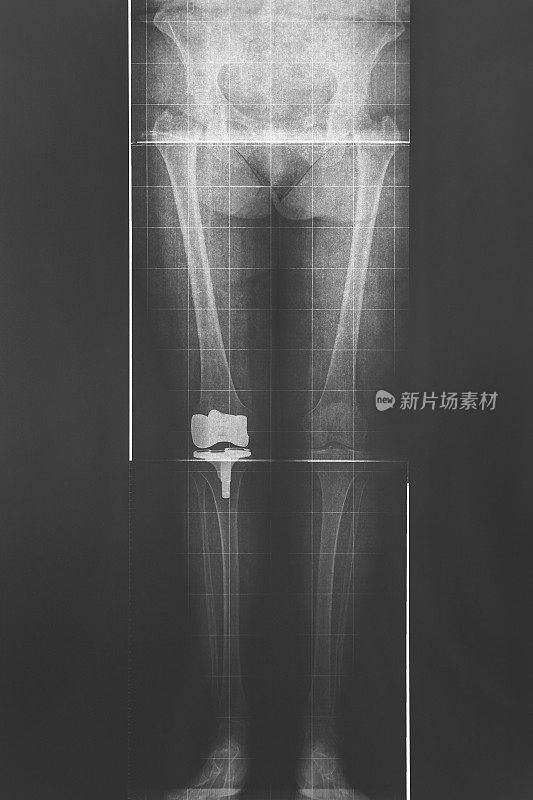 腿部和臀部x光片。钛膝关节植入物。Radiodogy诊断