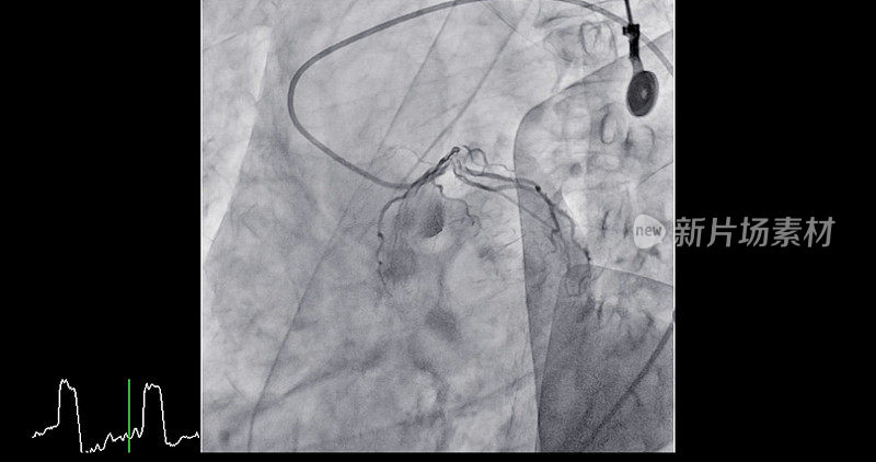 心导管插入术是一种用于检查心脏血管的医疗程序。