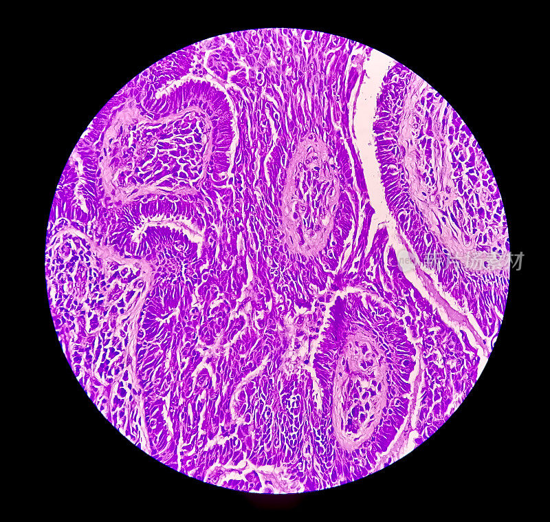 子宫内膜癌认识:子宫活检显微照片显示子宫内膜癌或子宫内膜癌。