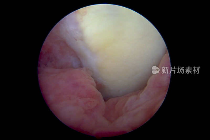 关节镜下左膝有关节炎引起的滑膜炎和软骨病变