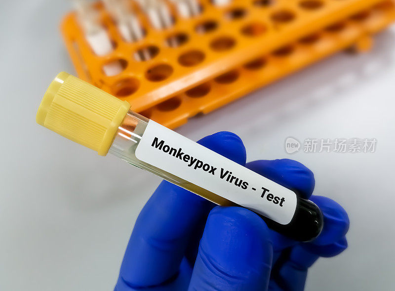 猴痘病毒检测的血液样本。它也被称为Moneypox病毒，一种双链DNA病毒和痘病毒科的成员。