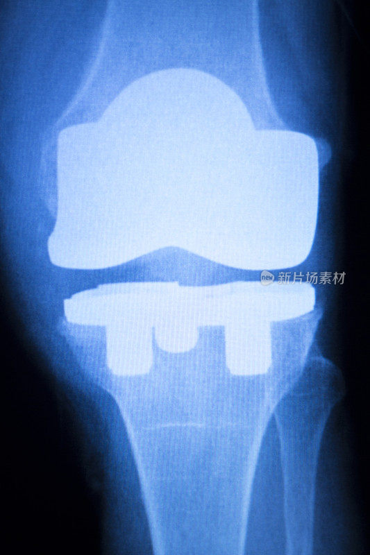 膝关节植入物x线检查扫描