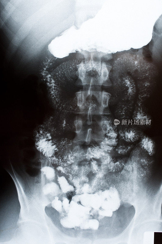 人的胃和小肠的x光片