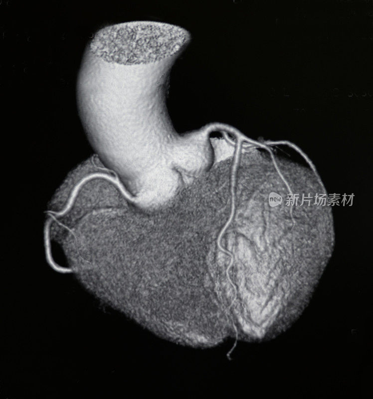 容积显示心脏和冠状动脉的CT图像