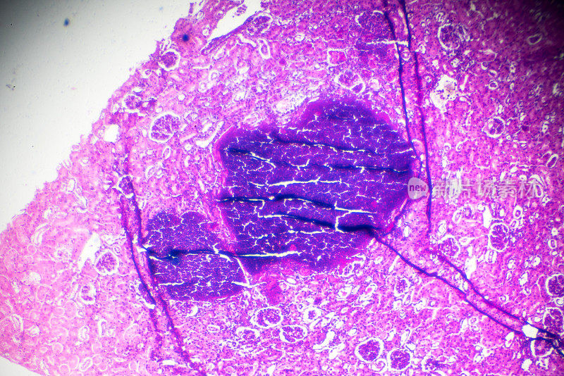显微镜下急性肾盂肾炎活检标本