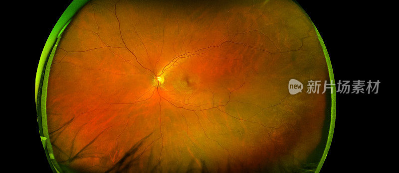 在黑色背景下，有黄斑、血管和视盘孤立视图的眼睛视网膜角度图像。超宽眼底相机制作