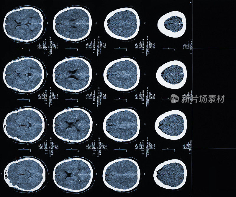 人脑的CAT扫描