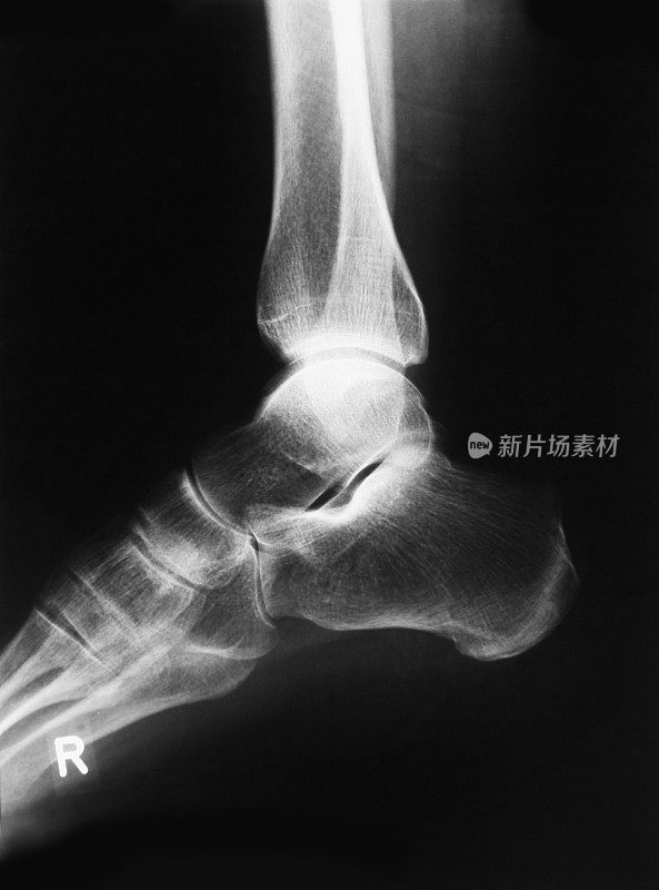 人脚的x光片