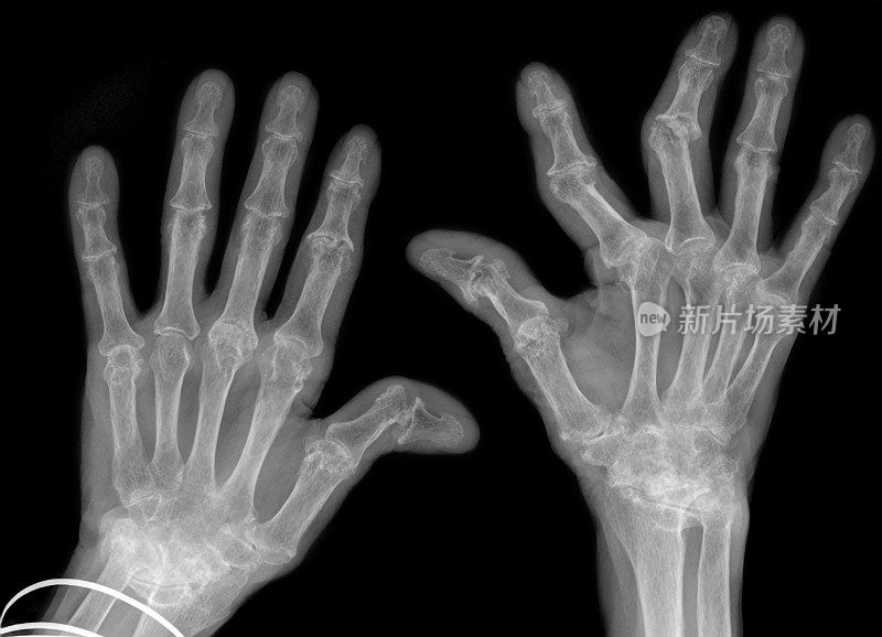手部x光片显示晚期类风湿性关节炎