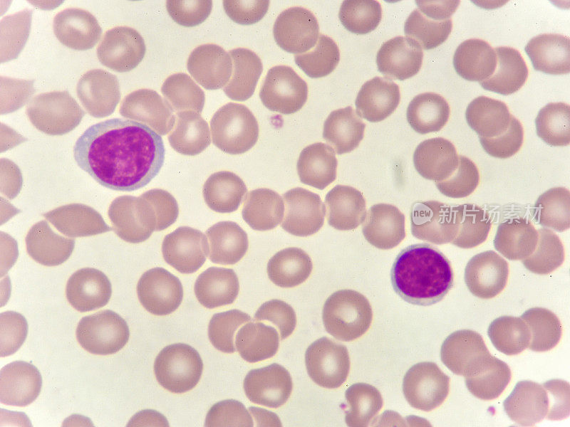 白血病细胞
