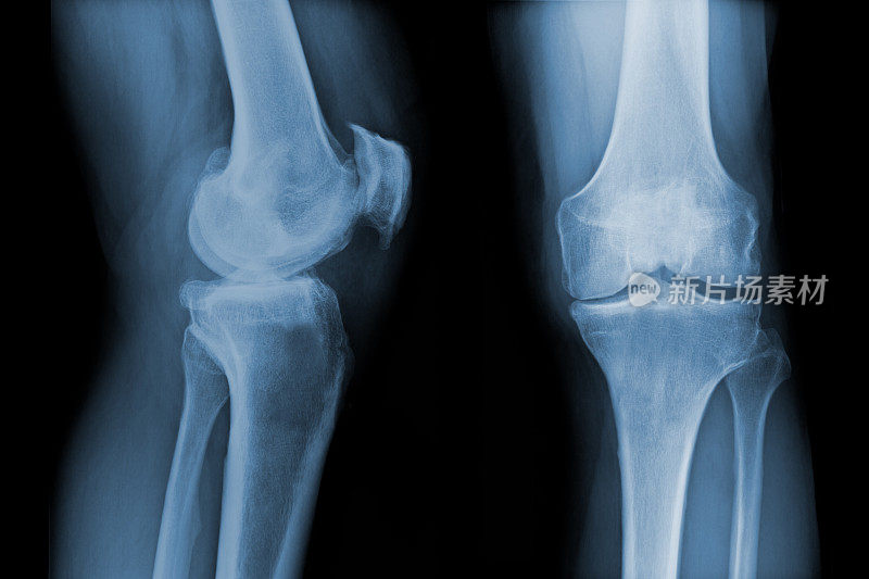 全膝关节置换术前伴有骨性关节炎的膝关节x线照片。正面和侧视图。
