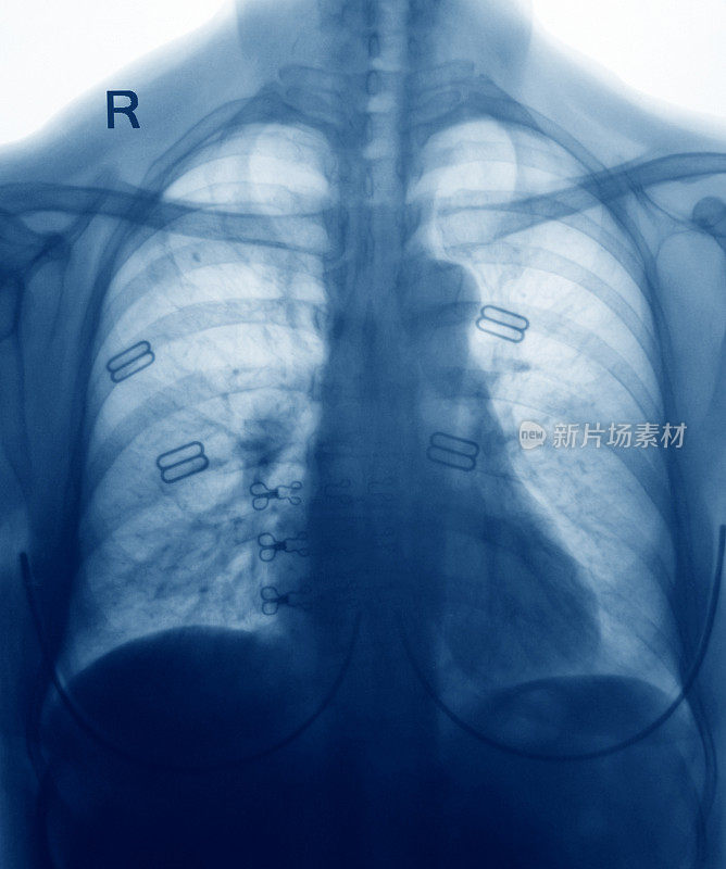 胸部x光图像