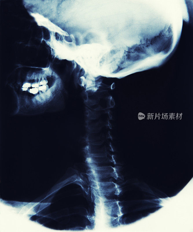 X光图像显示头骨，颚和脊柱