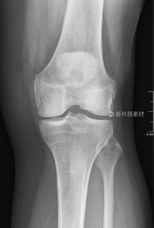 膝关节软骨损伤的RX