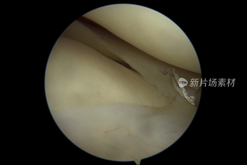 关节镜下内半月板中段桡骨撕裂用全内缝合技术修复