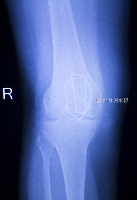 医用骨科创伤学扫描显示膝关节植入物螺钉x线。