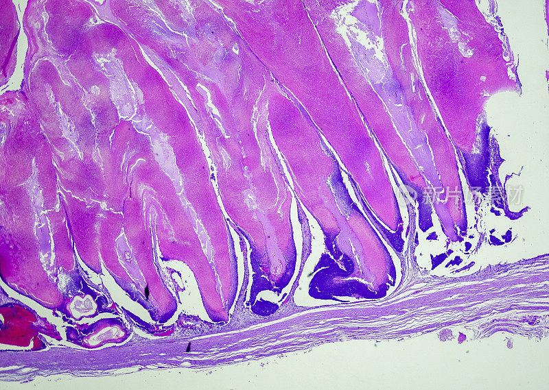 Pilomatricoma