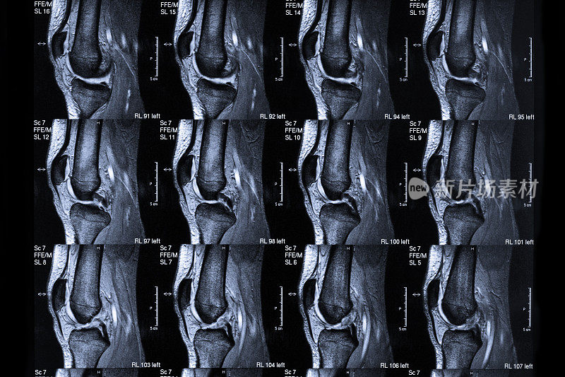 磁共振扫描人膝