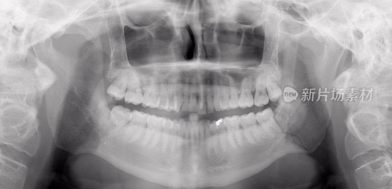 颌骨的x光数字正位片显示骨折
