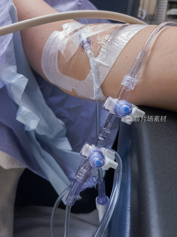 在医院接受过手术的成熟女性手臂上的输液器