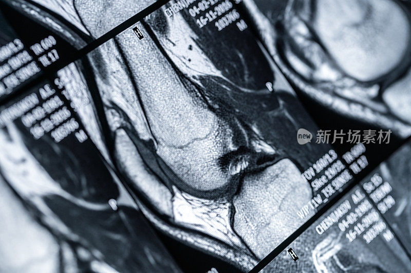 膝关节MRI扫描