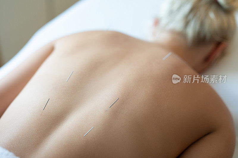 女性背部与钢针针灸治疗过程中。
