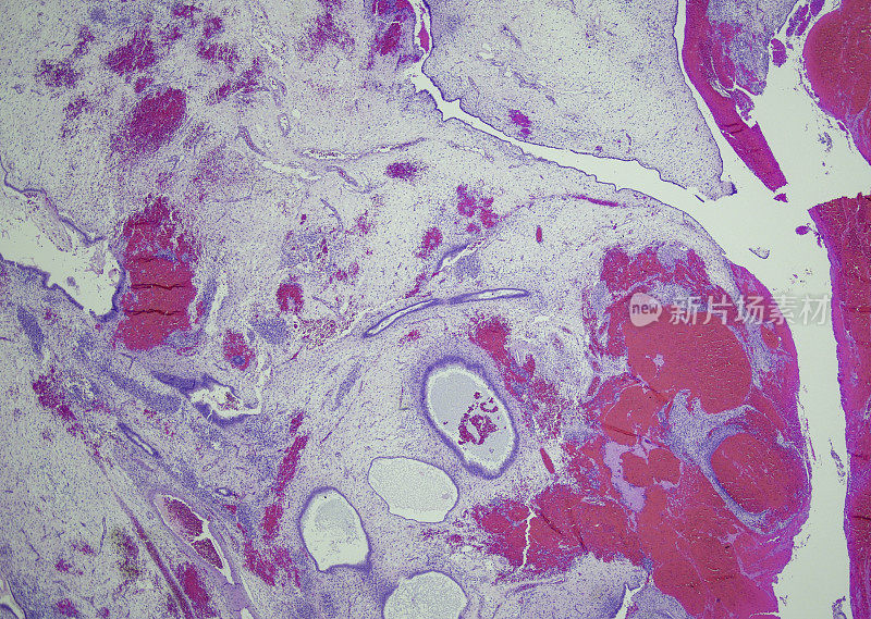 胚胎性横纹肌肉瘤