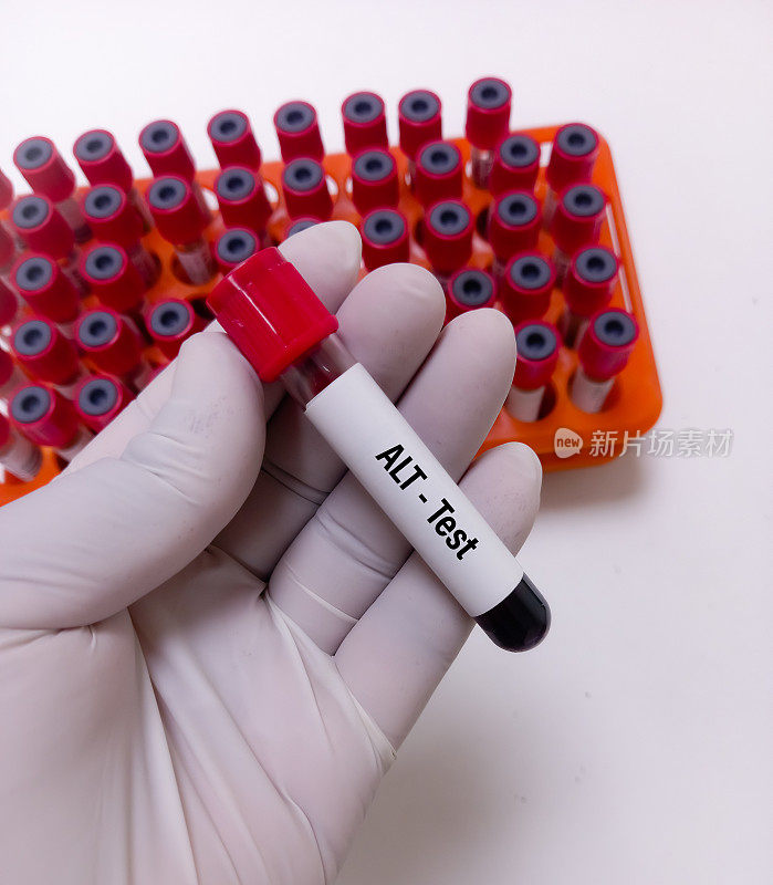抽血做谷丙转氨酶(ALT)或SGPT测试，肝功能测试。ALT血检。