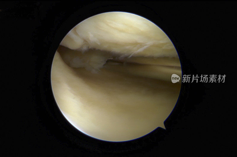 患有轻度至中度骨关节炎的人右膝内侧腔室的关节镜视图