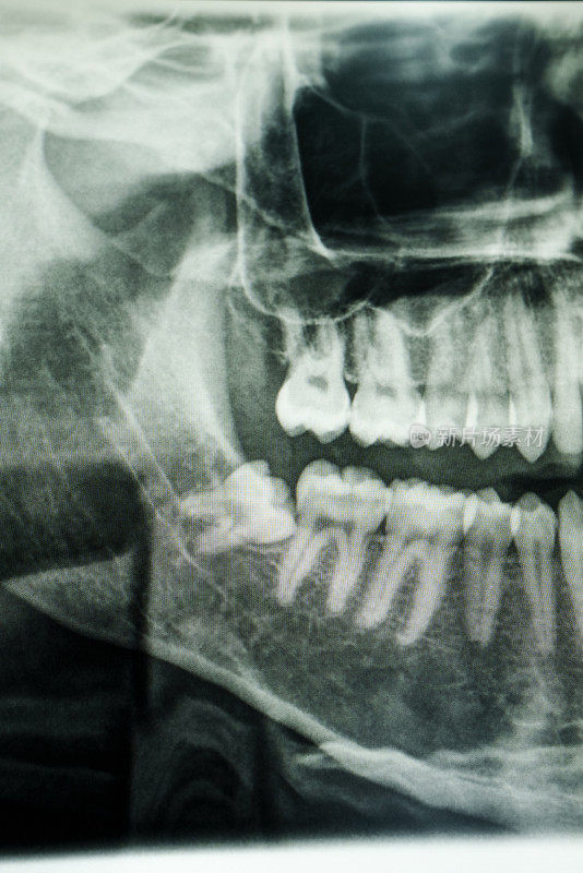 埋藏智齿的x光图像