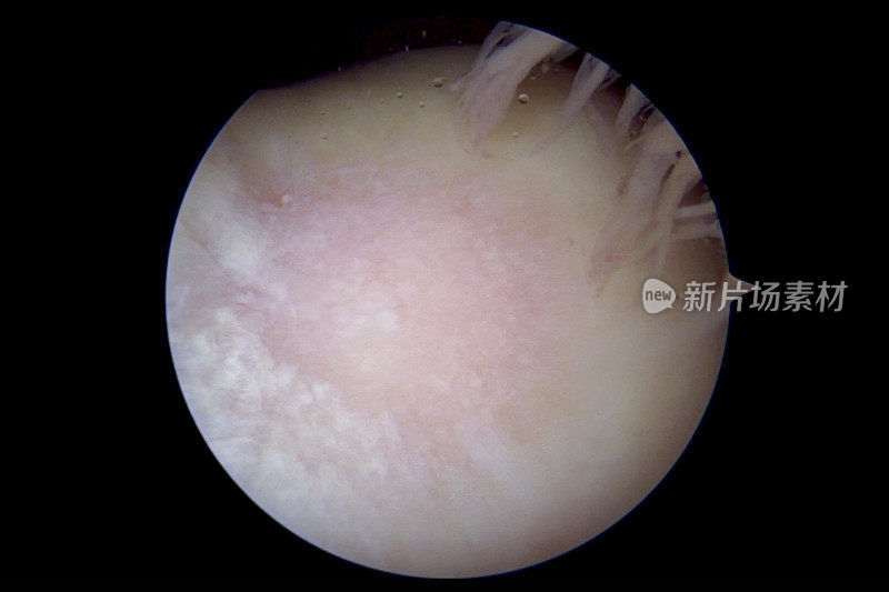 骨关节炎患者膝关节的关节镜观察