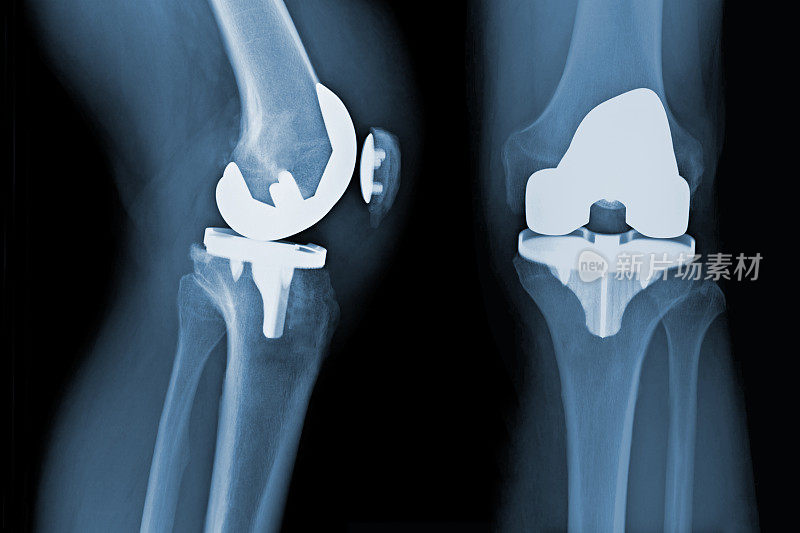 全膝关节置换术x线-骨关节炎
全膝关节置换术前x线检查-骨关节炎